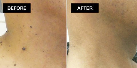Skin Mole Removal Patch 7